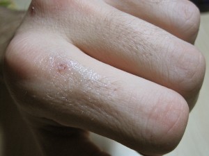 Burt's Bees applied Cuticle Creme small cut greasy